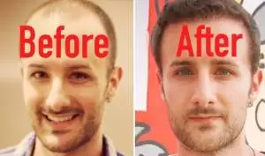 Hair Transplant