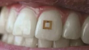tooth-sensor